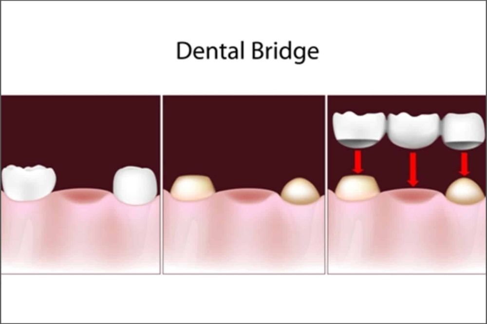dental bridges in saskatoon