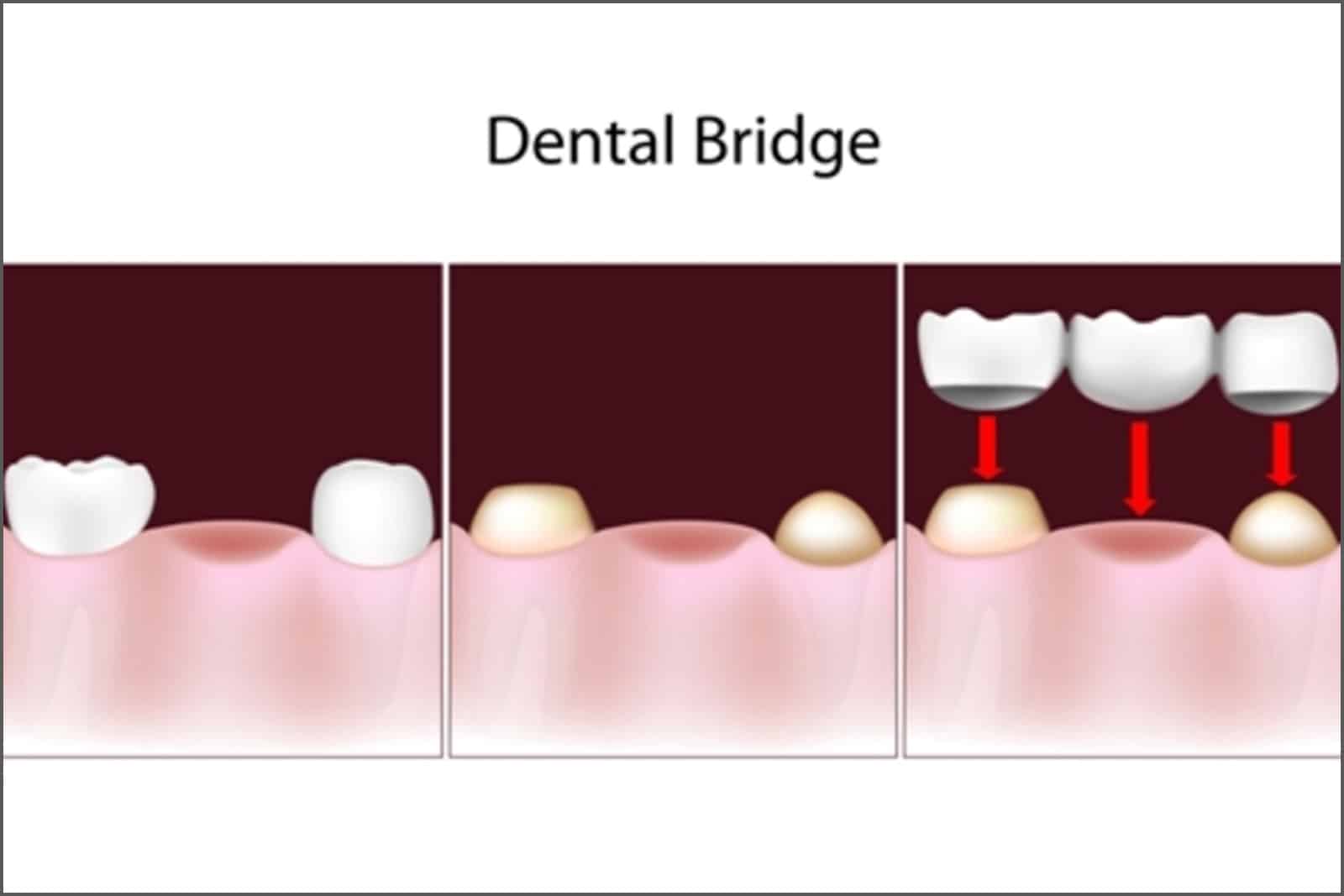 dental bridges in Saskatoon