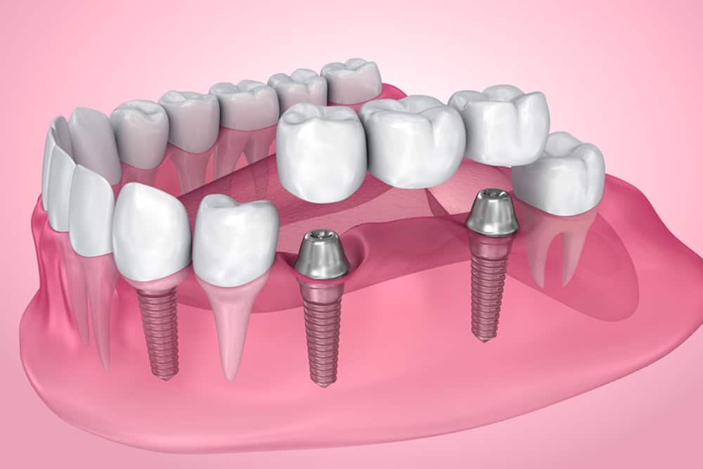 dental implants in saskatoon