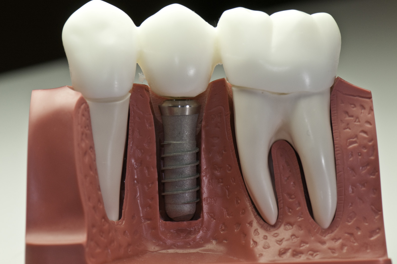 everything you need to know about dental implants