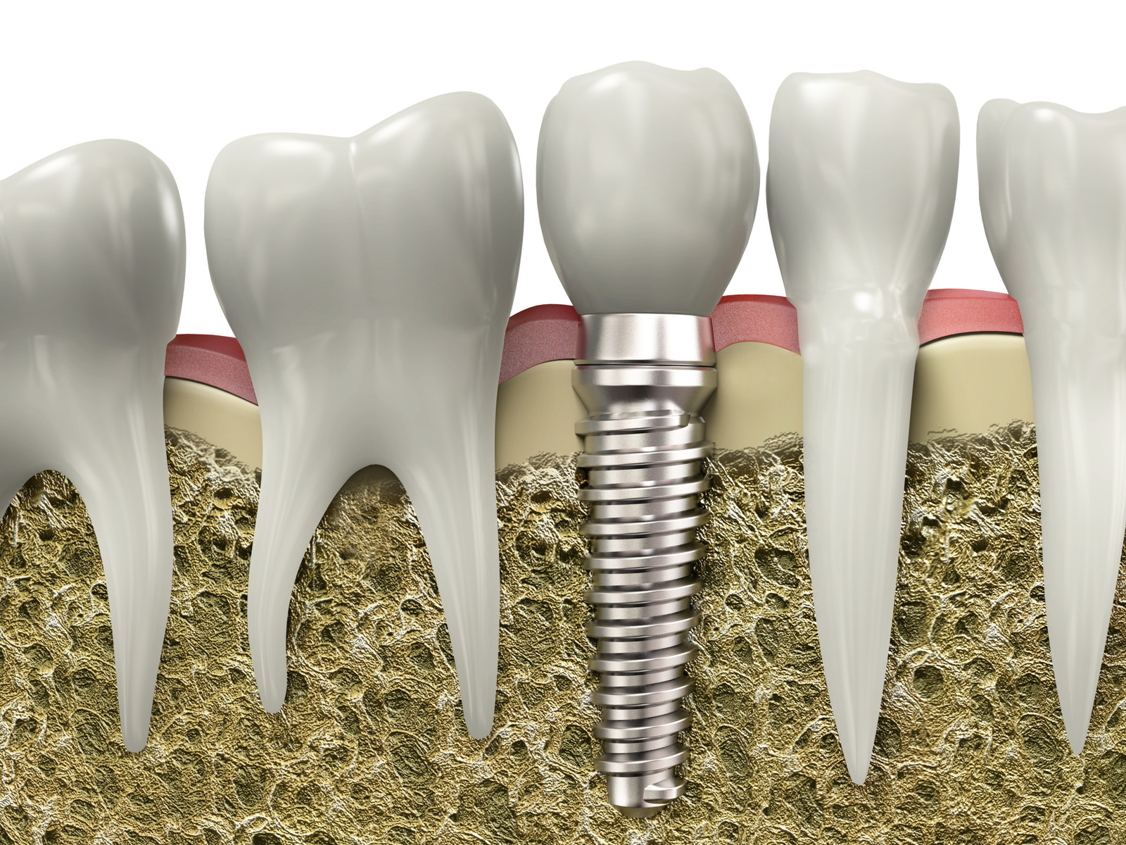 what dental implants can do for you