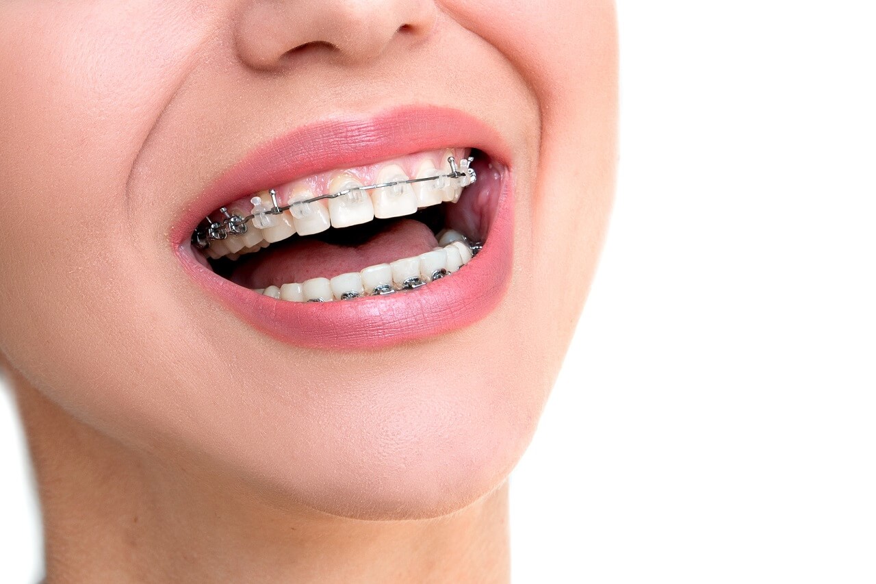 what braces options are available