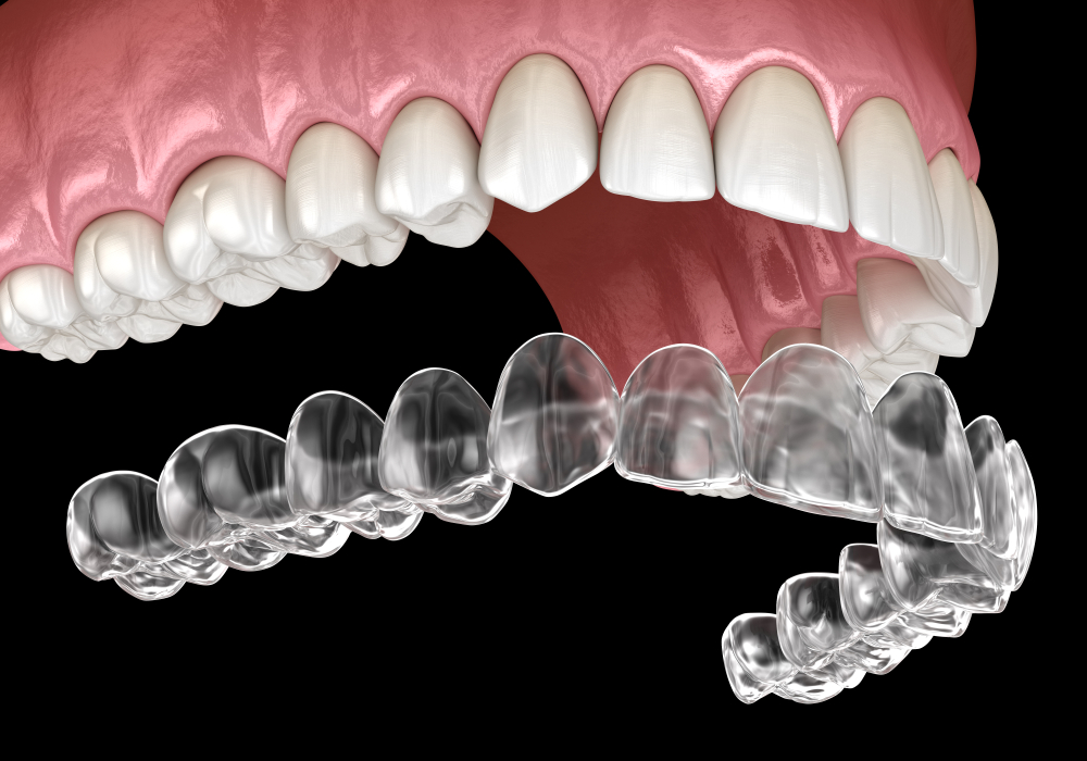 can you get invisalign for just your top teeth