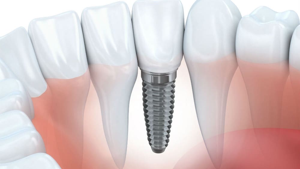Why Are Dental Implants So Expensive