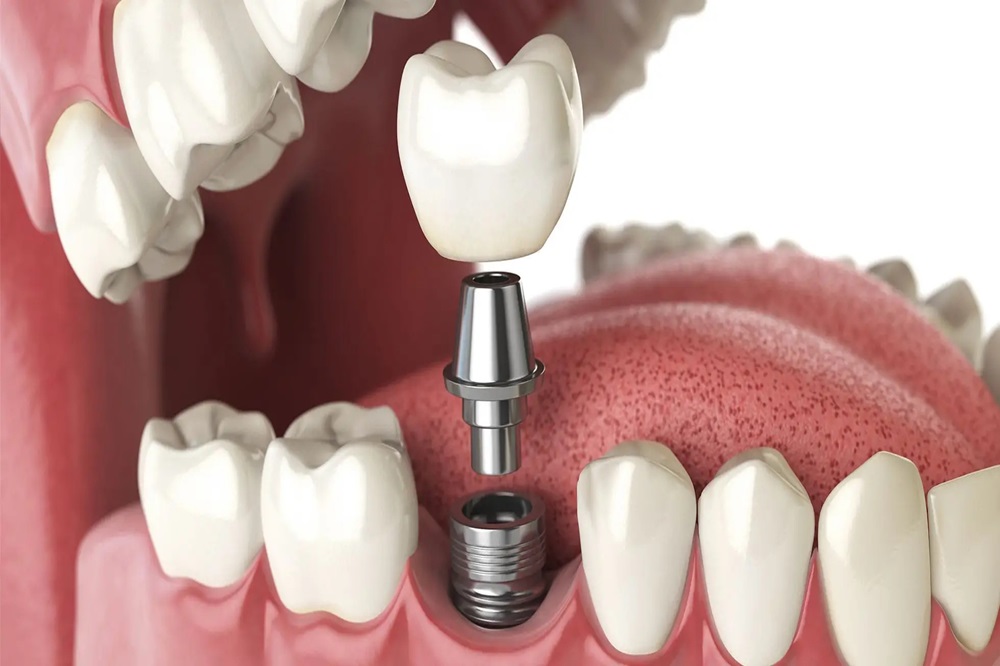 dental implants in Saskatoon