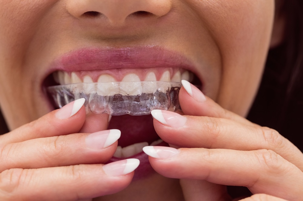 man wearing invisalign