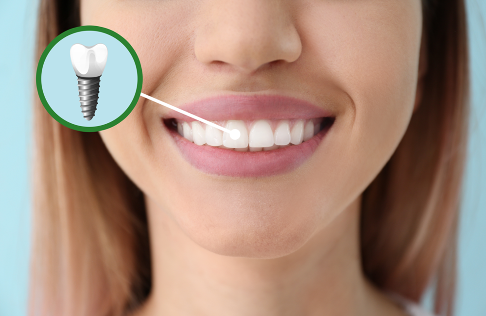 dental implants in Saskatoon