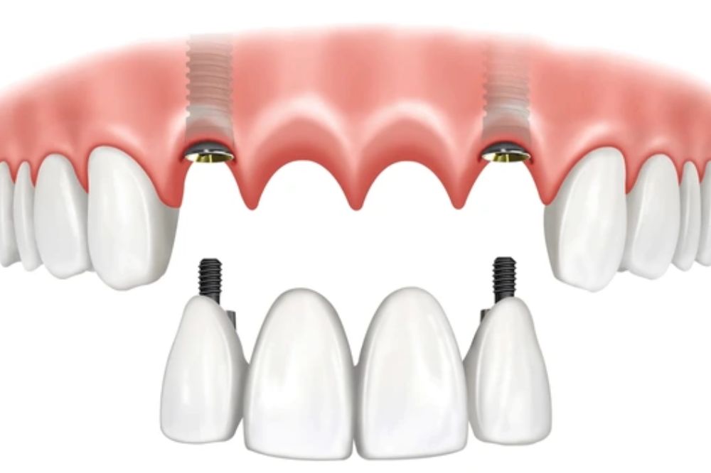 how many teeth can be replaced with implants